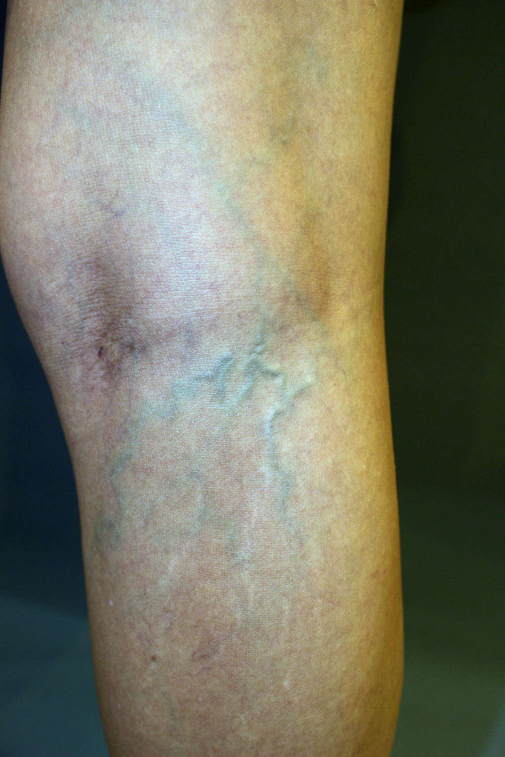 ひざ裏の青い血管 下肢静脈瘤 医師ブログ アヴェニューセルクリニック