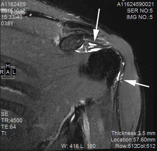 左肩MRI.png