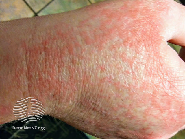 COVID-hand-dermatitis-02__WatermarkedWyJXYXRlcm1hcmtlZCJd.jpg