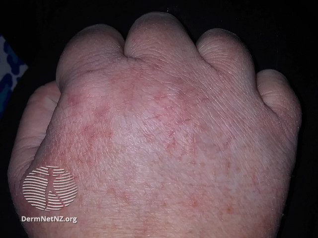 COVID-hand-dermatitis-03__WatermarkedWyJXYXRlcm1hcmtlZCJd.jpg